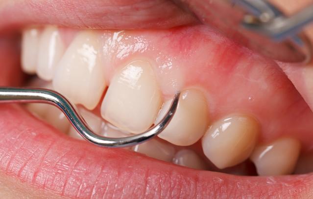 A close-up of upper teeth being held by dental tools to remove plaques